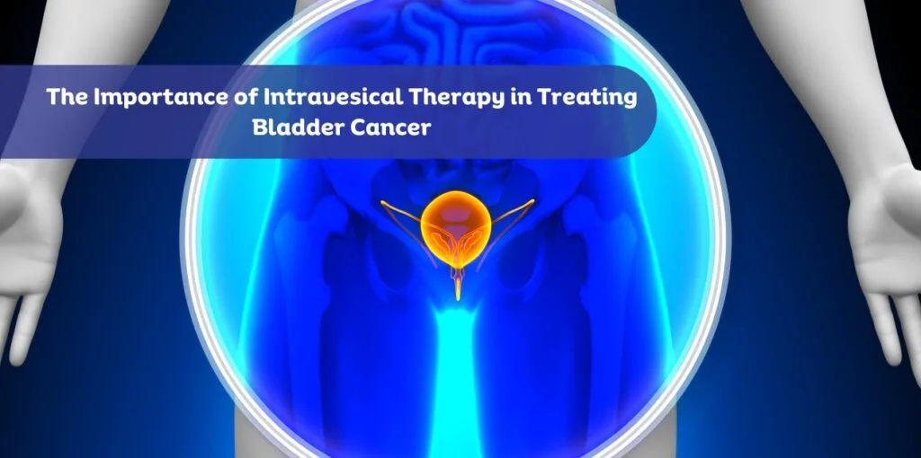 The Importance of Intravesical Therapy in Treating Bladder Cancer