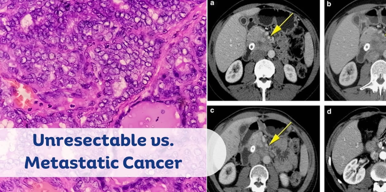Unresectable vs Metastatic Cancer