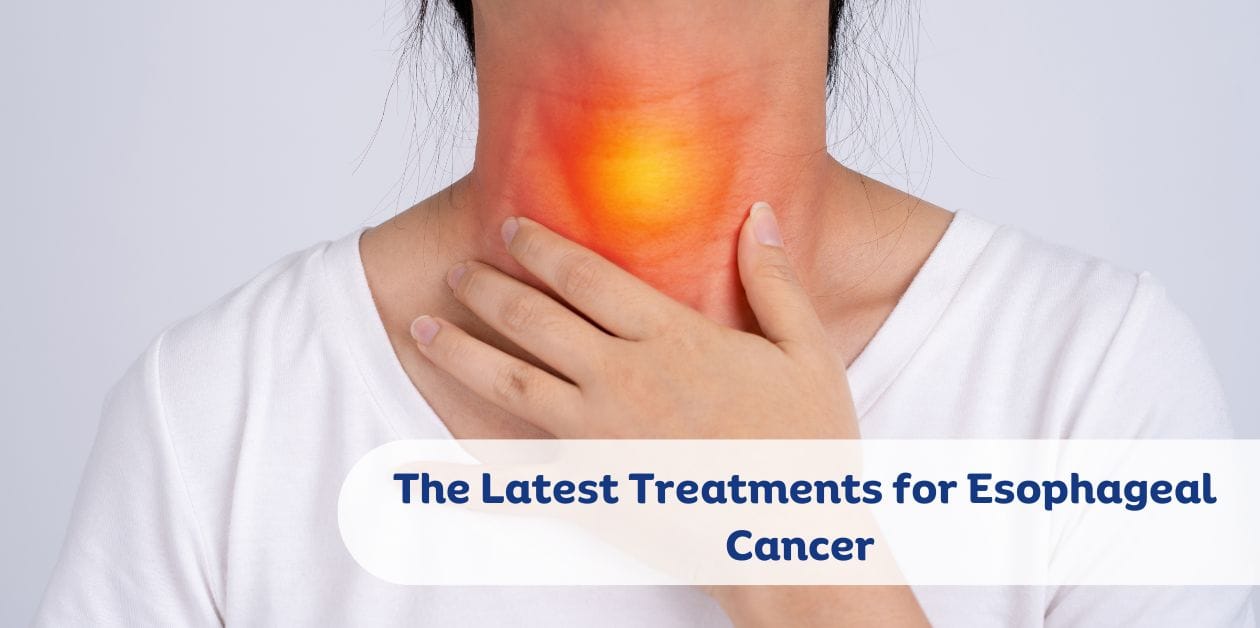 The Latest Treatments for Esophageal Cancer