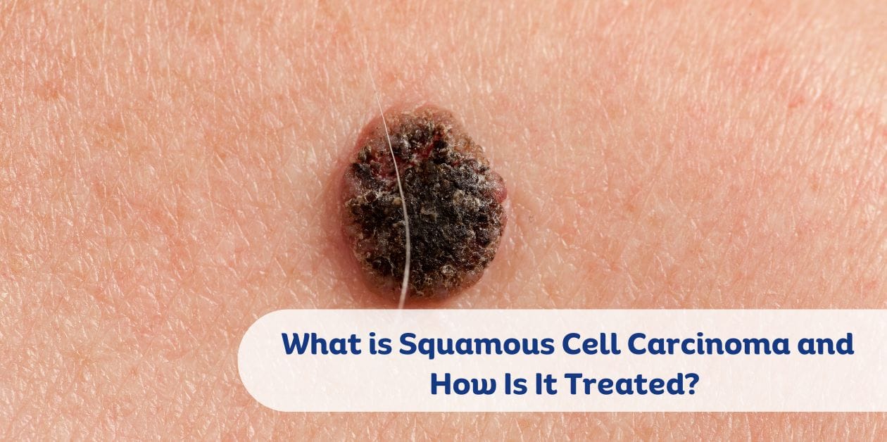 What is Squamous Cell Carcinoma and How Is It Treated?